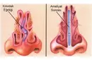 Burun Ameliyatı Kıkırdak Alma