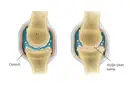 Kıkırdak Aşınması Belirtileri ve Tedavisi