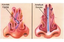 Burun Kıkırdak Ameliyatı Riskleri ve Sonrası