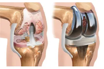 Kıkırdak Hastalıkları Nelerdir?