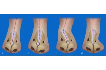Kıkırdak Kayması Belirtileri ve Tedavisi